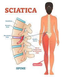 Sciatica Treatment Services
