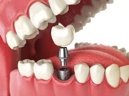 Dental Implant Treatment Services