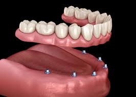 Full Mouth Implant Treatment Services