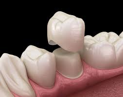 Ceramic Crowns Treatment Services