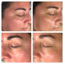 Carboxy Therapy for Instant Brightness