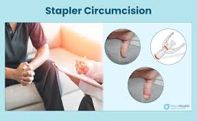 Stapler Circumcision Treatment Services