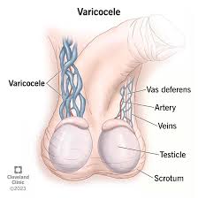 Varicocele- Microsurgical Varicocelectomy Treatment Services
