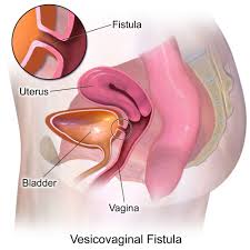 Urogynecology- Stress Incontinence ( TOT, TVT repair), VVF, UVF Repair Services